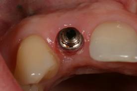 Имплантация зубов – установленный зубной имплант- ЗУБНАЯ КЛИНИКА - DENTAL SUITE - Германия