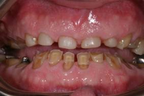 Имплантация зубов – фото ДО имплантации зубов - ЗУБНАЯ КЛИНИКА - DENTAL SUITE - Германия