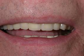 Имплантация зубов – фото ПОСЛЕ имплантации зубов - ЗУБНАЯ КЛИНИКА - DENTAL SUITE - Германия