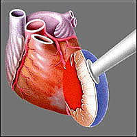   Heart Laser,     ,      