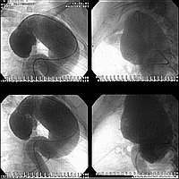 Ангиограмма аневризмы всей грудной аорты: поражены восходящая и нисходящая части и дуга аорты 