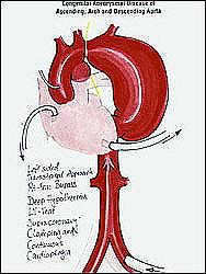 Схема операции по протезированию аневризмы. АИК подключается к бедренной артерии, сердце разгружается с помощью вента 