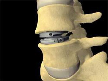 Вертебропластика