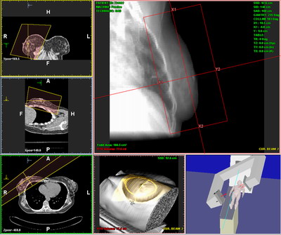 Эластрография