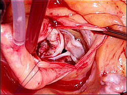 Вид на кальцифицированный аортальный клапан со стороны разреза восходящей аорты 